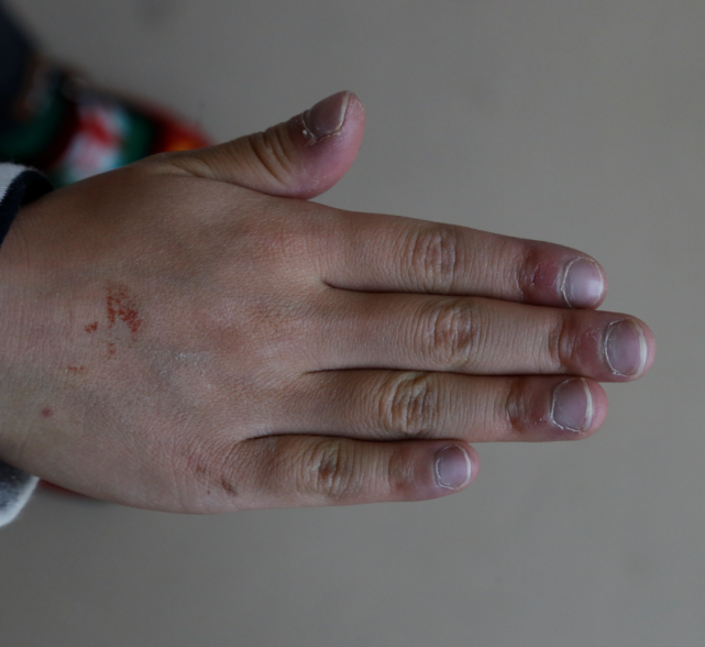 一眼,就可以明显看出她和正常的孩子不同:发紫的嘴唇,杵状手指和脚趾