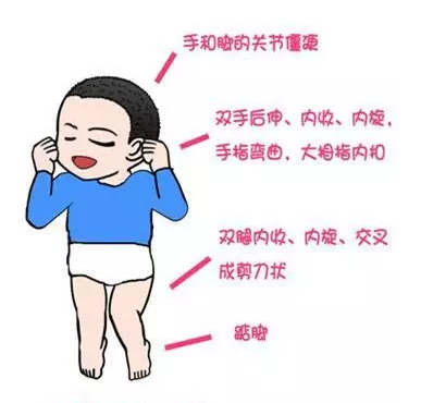 脑瘫等同是偏瘫孩子患上脑瘫还有治愈的可能吗