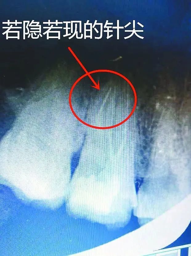 乾貨分享:對取根管內斷針的一點經驗|牙齒|根管治療|針頭