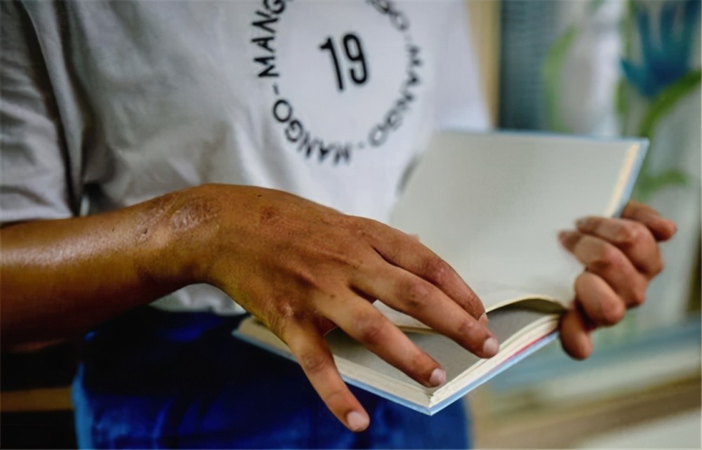 印度一名21岁女孩,失去双臂后移植黑人手臂,2年后全身逐渐变黑