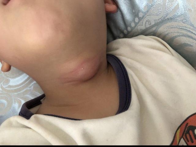 但也不排除是存在的,一些婴儿在出生之后就有先天性甲状腺功能减退症