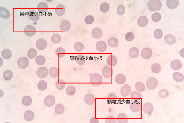 畸形血小板图片图片