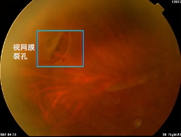 从外因来说,主要是外力的突然冲击,通过玻璃体的传导,导致视网膜破裂.