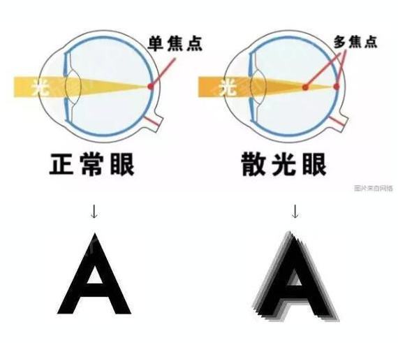 也有些後天引起的散光,比如眼瞼長針眼或粟粒腫,長期用