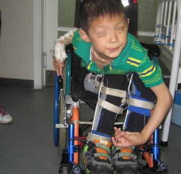 我所知道的复瘫饮 简单聊聊|复瘫饮|痉挛性截瘫|痿症|中药