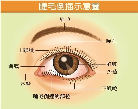 6岁男童泪流不止,眼红又眼痒,一查发现睫毛竟"倒着长"