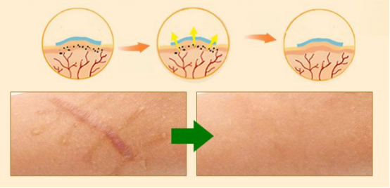 影响瘢痕修复快慢的这些因素你知道吗