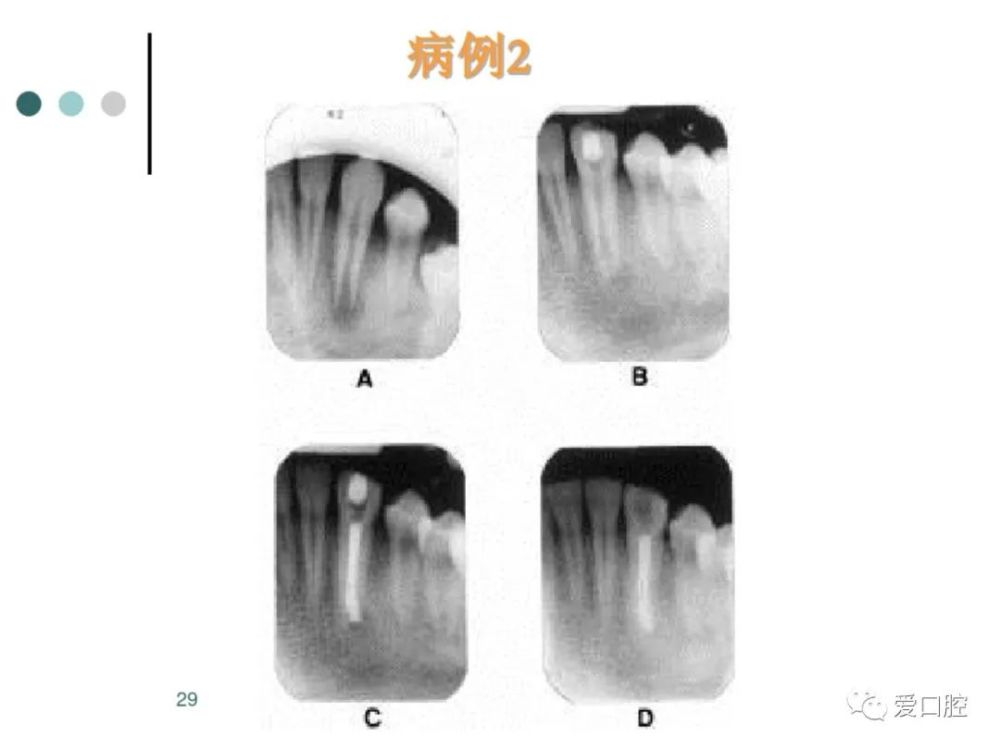 end 61往期推薦鈣化細小根管的處理技巧正確認識根管治療中的斷針