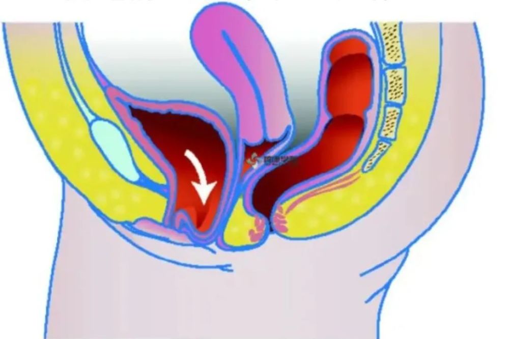 女性膀胱突出图片