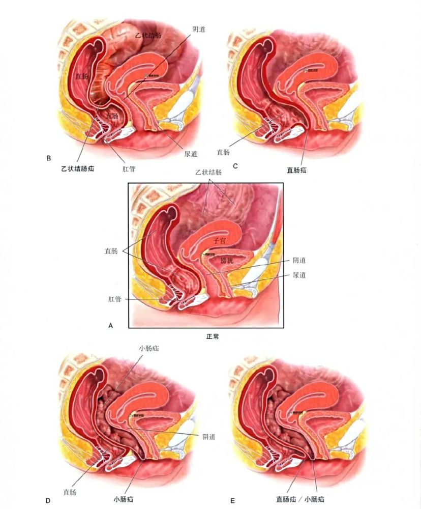 阴道穹隆处支持组织薄弱可形成直肠子宫陷凹疝,阴道后穹隆向阴道内