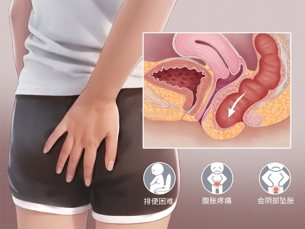 女性盆底功能障碍性疾病