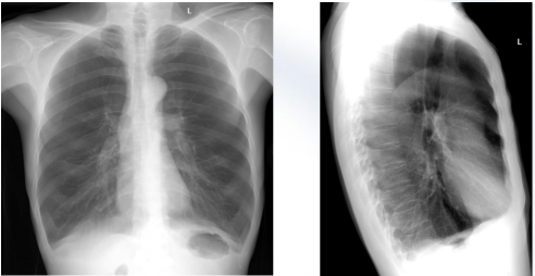 曾庆思教授慢性阻塞性肺疾病的影像表现及研究进展