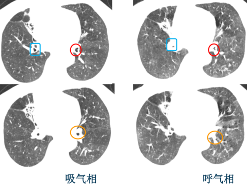 對比觀察,慢性支氣管炎的管腔狹窄很明顯,管壁增厚,左下肺的管壁增厚