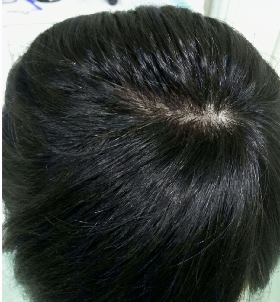 孩子头顶有"两个旋",就意味着孩子聪明?医生告诉你答案