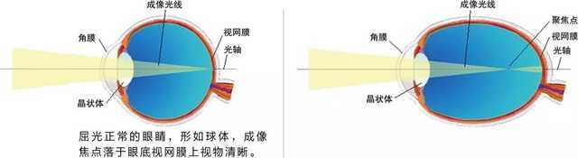 物體正常聚焦,其焦點落於視網膜之前,當成像光線到達眼底視網膜時