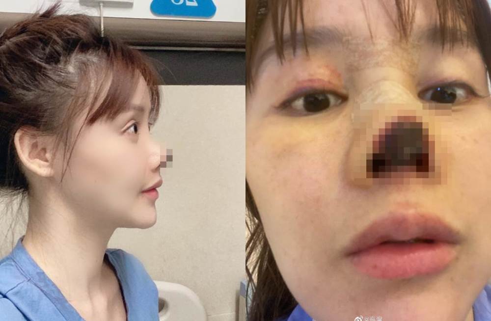要努力耕耘事业之际,021年2月她闪电晒出自己鼻子变黑缺一角的毁容照