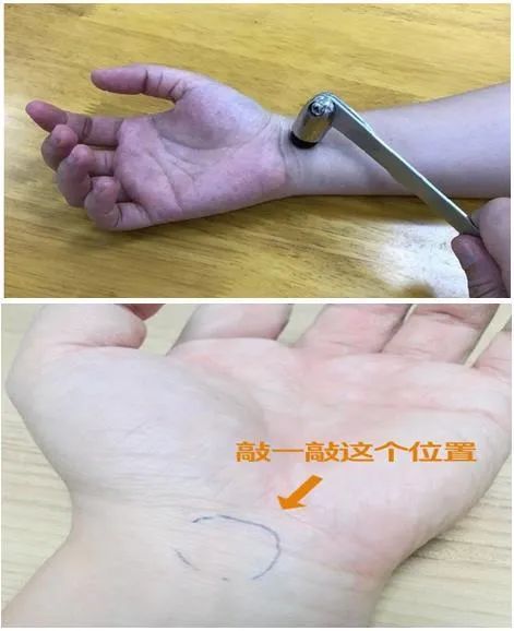自我测试二:tinels试验(神经干叩击试验)(您是否有出现拇指,食指