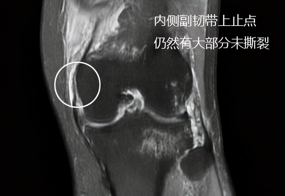 发生了较大撕裂,但是在核磁上我们发现内侧副韧带损伤相对来讲不是特