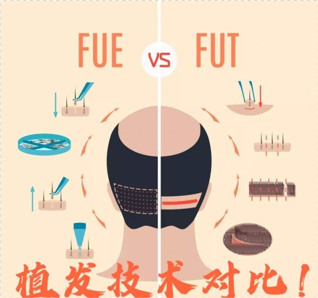 fue,sht和fut植发技术的区别!_腾讯新闻