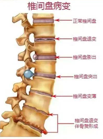 腰痛腰在喊救命椎间盘问题越早发现越能复原