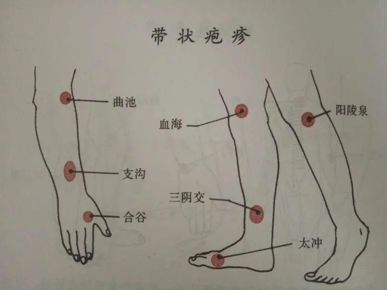 带状疱疹早期针灸治疗很重要