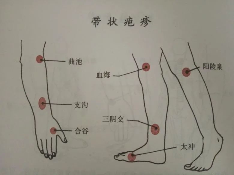 帶狀皰疹早期針灸治療很重要,否則……_騰訊新聞