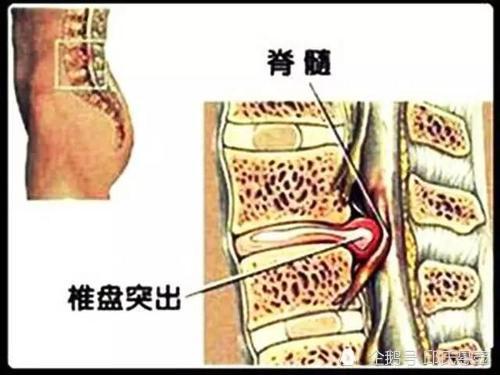 腰椎间盘突出腰斜腿麻该怎么办!邱氏悬壶