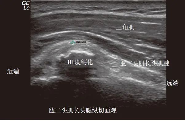 疼痛解剖学肱二头肌长头肌腱断裂ludington试验