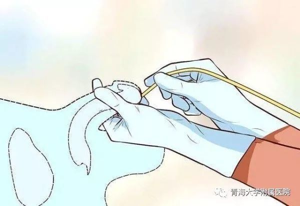 导尿常见的问题及护理措施