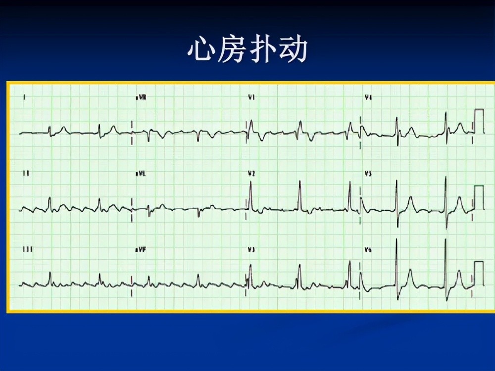 如何利用心電圖