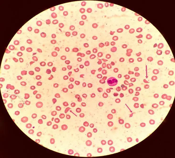 生死速递一张血涂片为患者争取到宝贵的抢救时间
