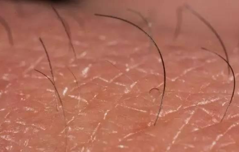 孩子背上长出怪毛妈妈直接薅断不料把娃薅进了icu