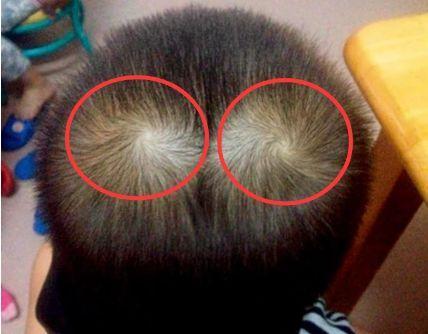 为什么有的孩子头上有2个旋预示性格还是命运