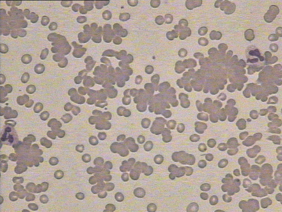 引起红细胞凝集的原因有很多,如冷凝集素,自身抗体,低白蛋白血症等