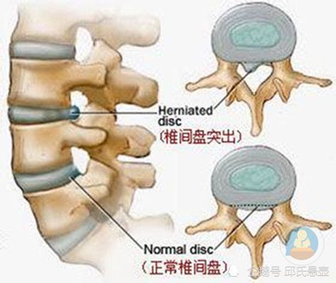 腰椎间盘突出压迫神经腿疼怎么治邱氏悬壶