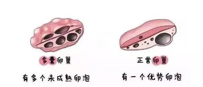 多囊卵巢能正常怀孕生小孩吗?