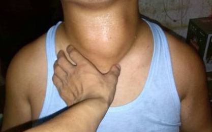 甲状腺发生癌变,身体有4个信号提醒!有这几种情况,检查甲状腺