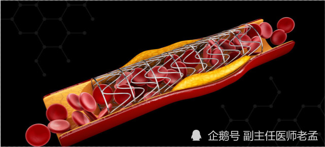 做完心脏支架手术后,还用继续服药吗?