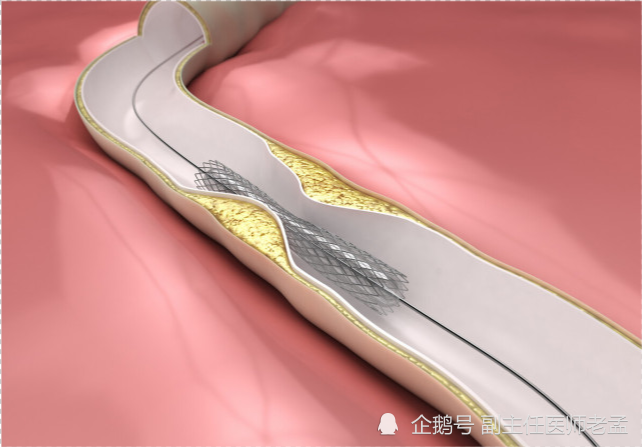 做完心脏支架手术后,还用继续服药吗?