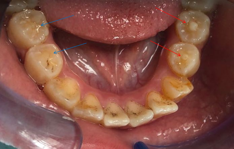 发生剧痛的这颗新萌出的恒牙,和其他牙齿相比,它中间多长了一个牙尖.