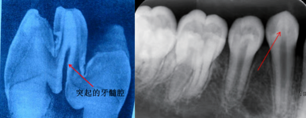畸形中央尖中高耸的牙髓组织.part 03.有没有办法预防"中央尖"折断?