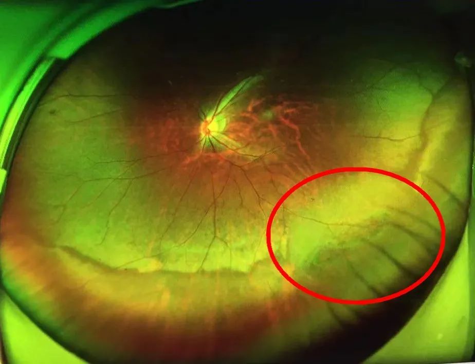 飞蚊症不管行不行?_腾讯新闻