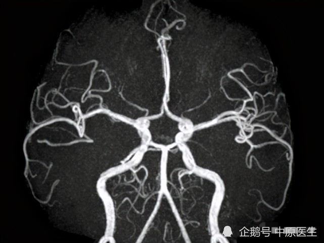 院長下令全院職工做頭部磁共振,多名年輕醫護人員查出腦血管狹窄