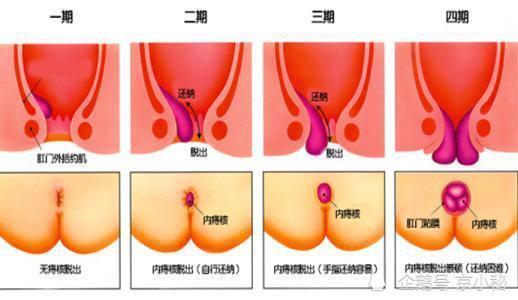 如何区分内痔外痔混合痔