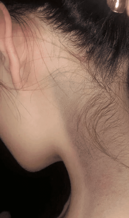 "女子睡一觉醒来后脖子青了一块,这怎么回事"哈哈哈哈来我家治