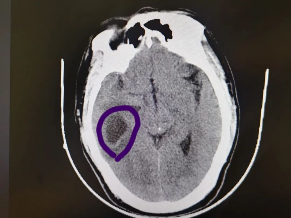 考虑应该不是脑部肿瘤,大概率是感染引发的严重脑膜炎