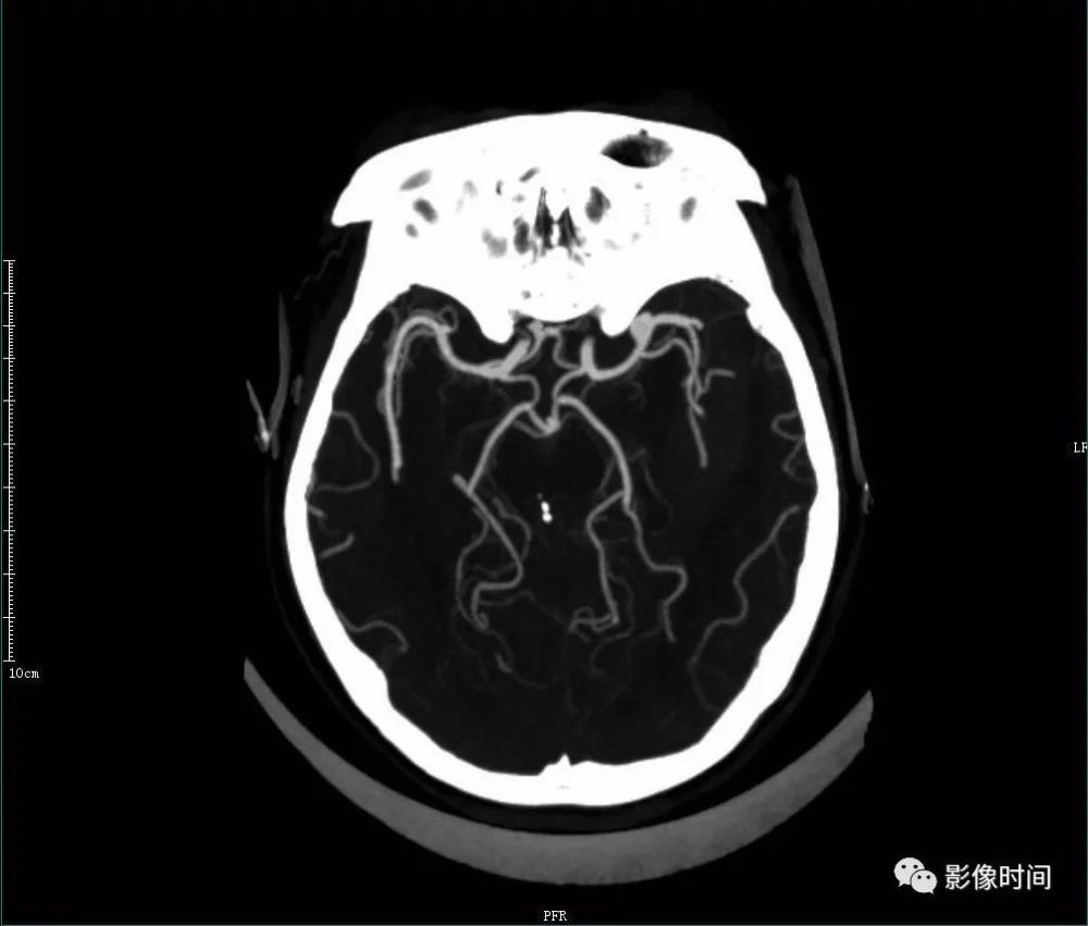 cta 示:大腦中動脈及右側椎動脈動脈瘤(大腦中動脈動脈瘤破裂出血)四
