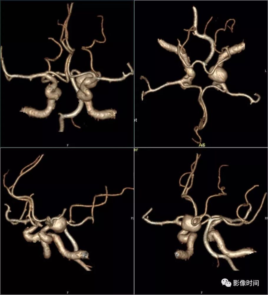 8個病例帶您一起復習顱內動脈瘤這些知識
