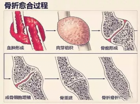 骨损伤康复不能只靠喝骨头汤健康长寿36计