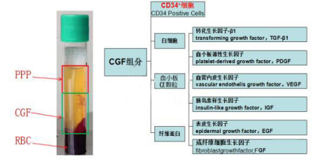 CGF软骨修复第三代再生医学技术:减缓